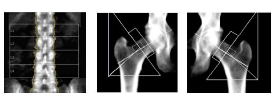 Bone density scan (DEXA scan) - How it is performed - NHS
